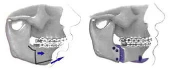 Diagram of sagital split osteotomies