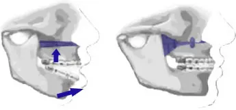 Diagram of Lefort 1 Osteotomy