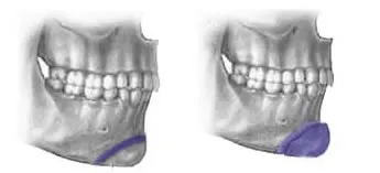 Diagram of Genioplasty