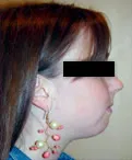 Patient 1 after chin repositioning