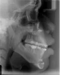 patient 3 xray profile after treatment