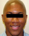 patient 3 smile after corrective jaw surgery
