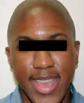 patient 3 before corrective jaw surgery