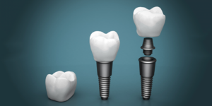 Dental-implants
