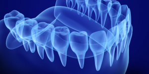 Bone Grafting can help patients replace missing teeth even with severe bone loss.