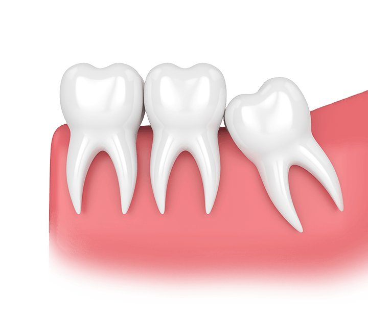 model of a wisdom tooth causing crowding in a mouth