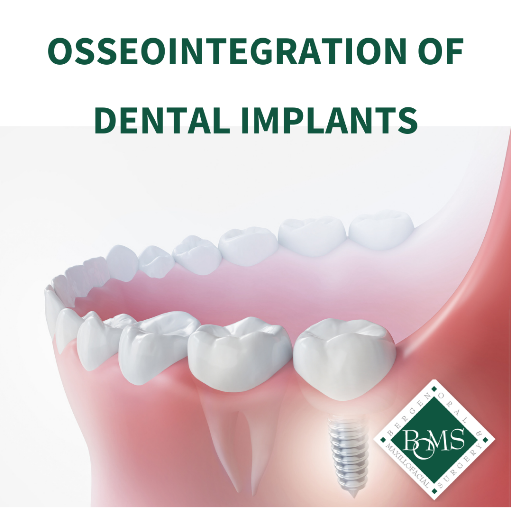 What is Osseointegration of Dental Implants? | NJ Oral Surgeons