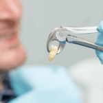 Complicated Tooth Extraction