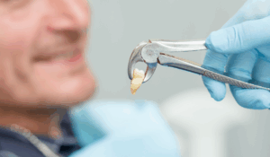 Complicated Tooth Extraction