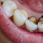 rotted teeth from smoking