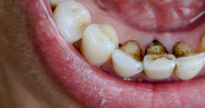 rotted teeth from smoking