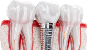 failed-dental-bone-graft