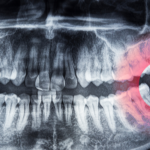 what-age-do-wisdom-teeth-come-in (1)