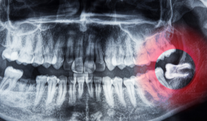 what-age-do-wisdom-teeth-come-in (1)