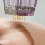 recovery-guide-what-to-expect-after-prf-microneedling-or-laser-treatments
