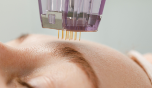 recovery-guide-what-to-expect-after-prf-microneedling-or-laser-treatments