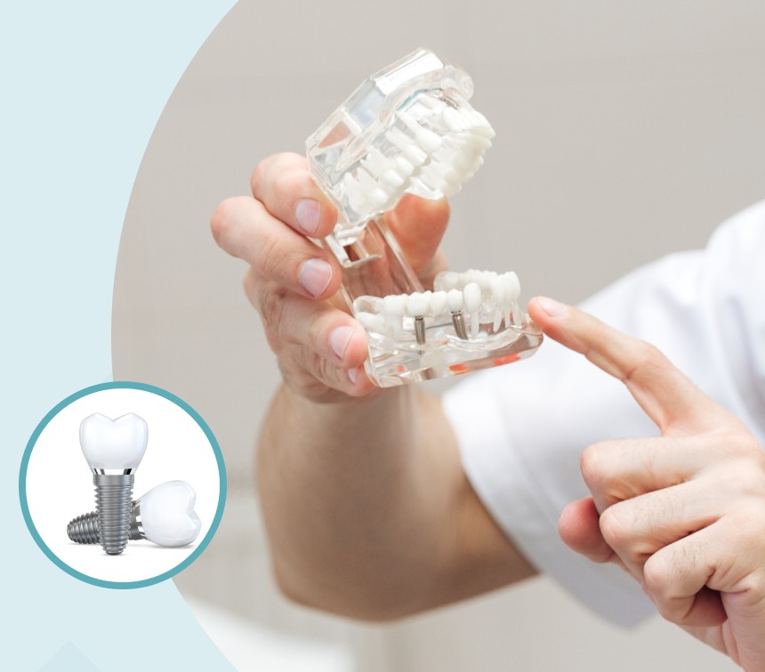 ao4-uvp-photo-mobile All-on-4 dental implant model