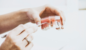 Dental Implants Affect Nutrition and Daily Life