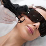 CO2 Laser Treatment