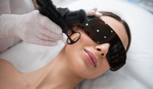CO2 Laser Treatment