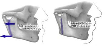 Diagram of Vertical Ramus Osteotomies