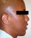 patient 3 after jaw correction
