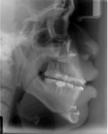 patient 3 xray profile after treatment