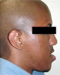 Patient 3 profile before jaw correction