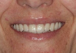Patient 4 smile after teeth replaced with all-on-4 solution