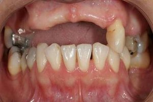 Patient 2 with only partial set of teeth remaining