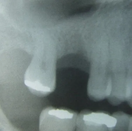 Xray post extraction of tooth