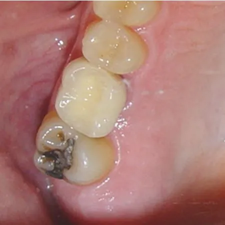 Final crown placed in mouth after dental implant (occlusal)