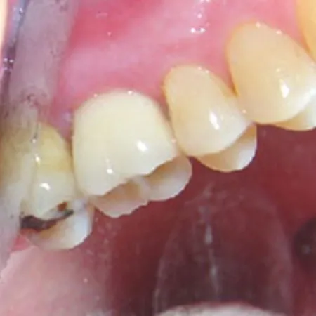 Final crown placed after dental implant (buccal)